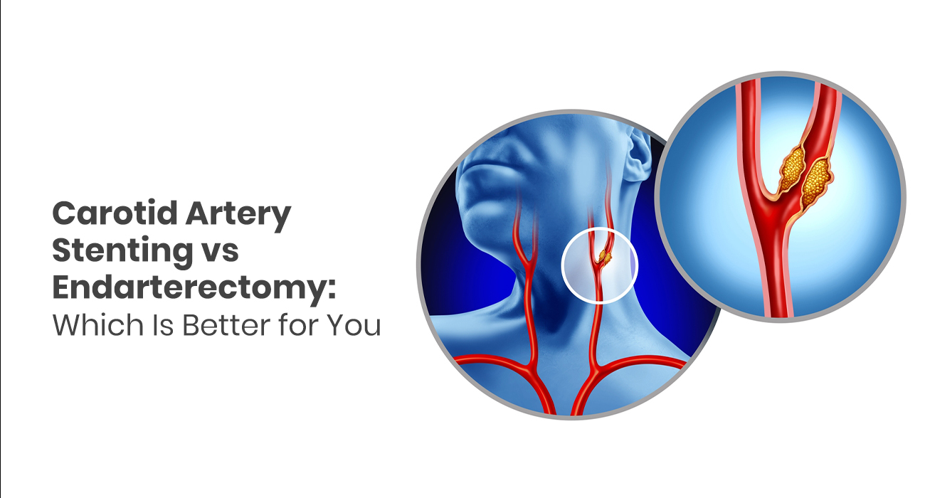 Carotid Stenting: A Life-Saving Procedure to Prevent Stroke